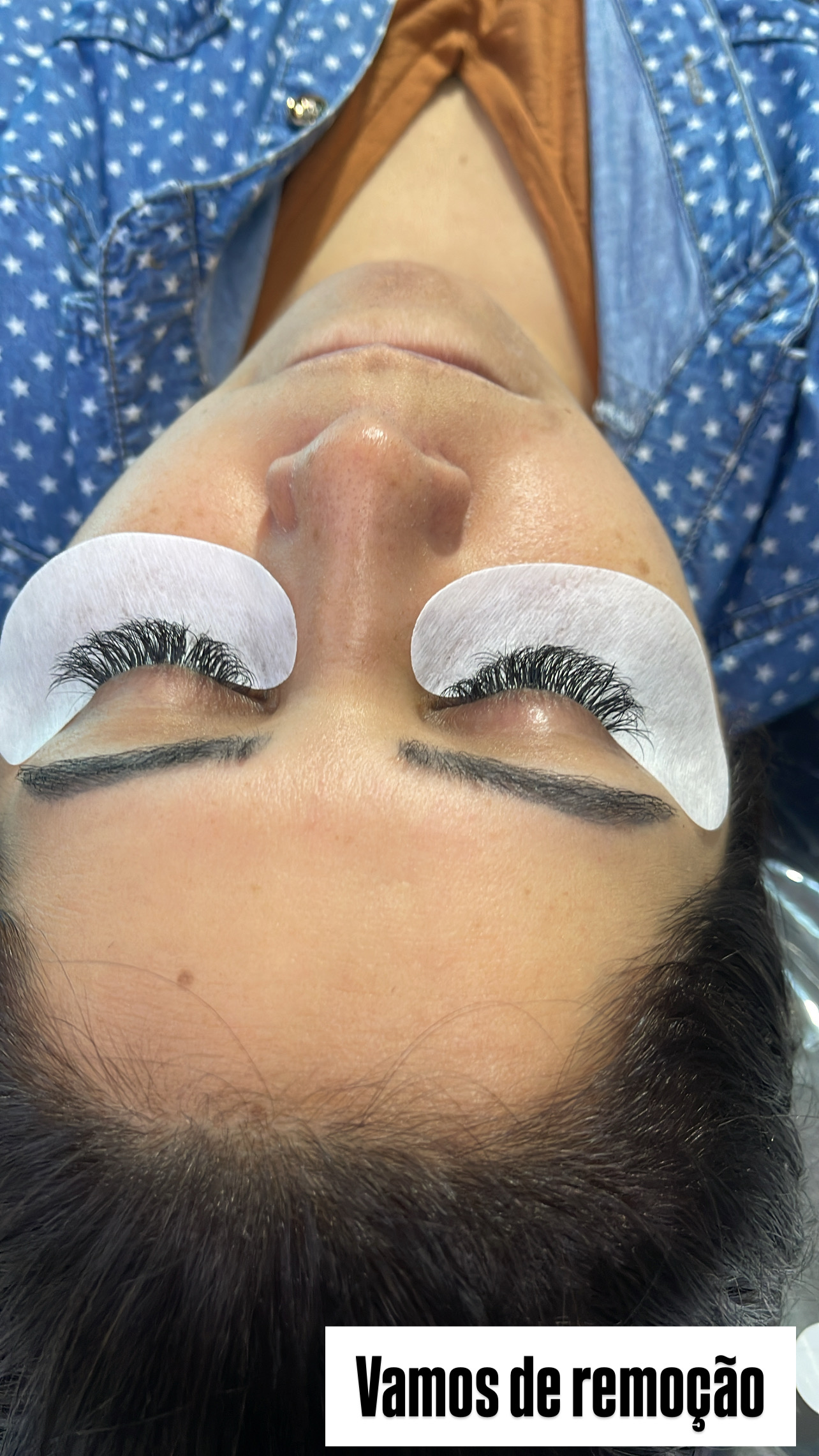 Remoção de Cílios